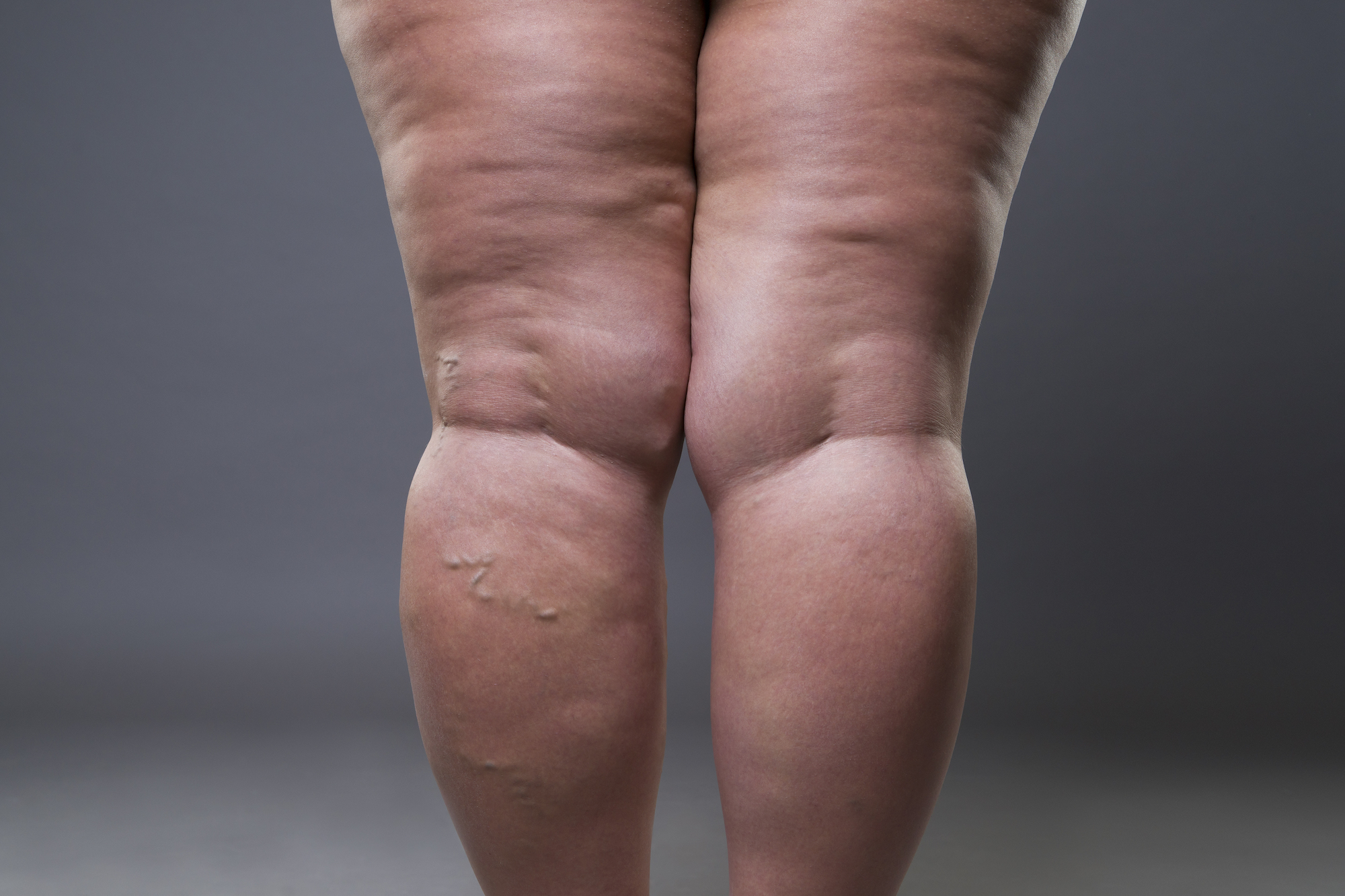 Legs showing lipedema-related swelling and heaviness
